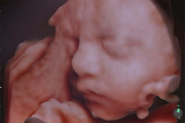 Tecnologia HD Live Ecografia 5D