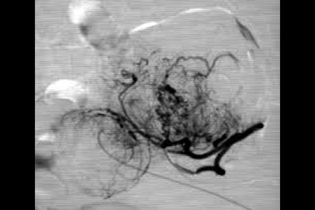 Tratamento de Miomas Uterinos