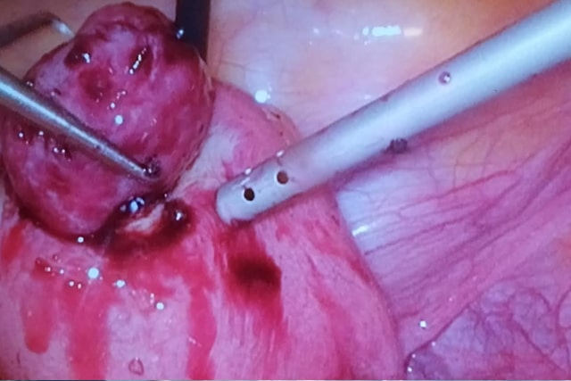 Extração mioma por laparoscopia