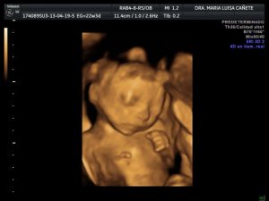 Ecografia 4D
