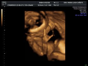 Ecografia 4D